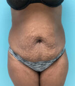 Tummy Tuck