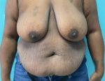 Tummy Tuck