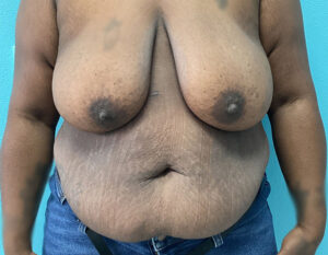 Tummy Tuck